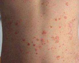 银屑病检查需要做哪些检查 银屑病检查需要做哪些检查