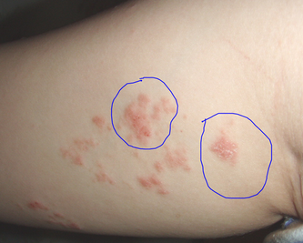 广州治疗牛皮癣医院教你如何防止身体脱屑 广州治疗牛皮癣医院教你如何防止身体脱屑