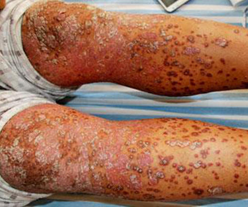 银屑病固定侵害部位