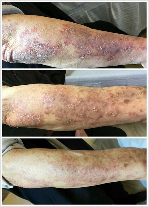 摆脱牛皮癣你猜听谁的