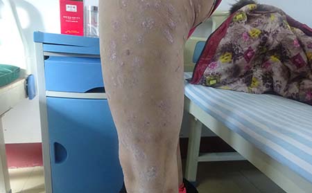 治疗牛皮癣注意什么