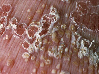 如何避免错误治疗牛皮癣