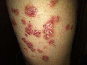 专业治疗牛皮癣的医院在哪