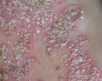 牛皮癣患者如何控制病情发展