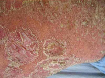 牛皮癣发病因素