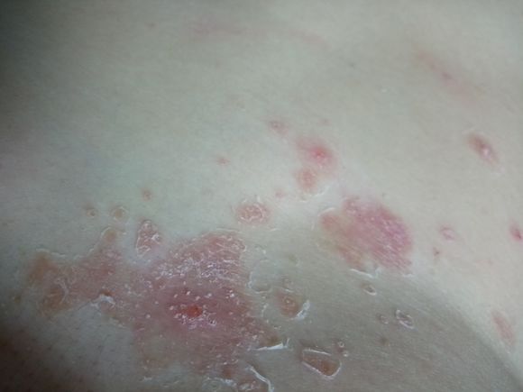 治疗牛皮癣用到的方法