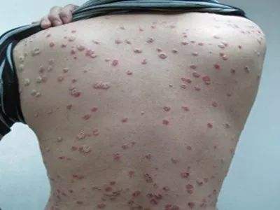 诊断银屑病三部曲