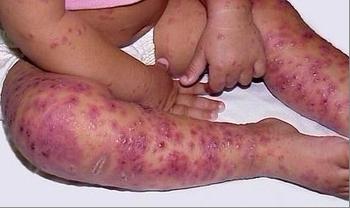 银屑病勿用偏方