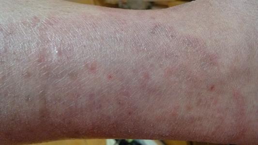 银屑病多久才会好