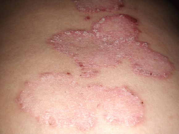 牛皮廯患者的饮食黑名单