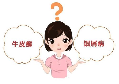 牛皮鲜患者对于药物治疗的误区有哪些 牛皮鲜患者对于药物治疗的误区有哪些