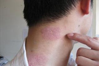 哪些方法可以缓解头部银屑病 哪些方法可以缓解头部银屑病