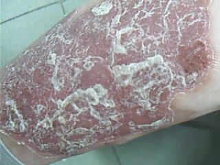 牛皮癣病人如何护理