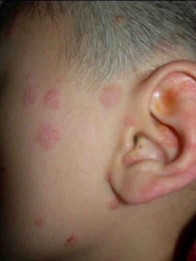 脸上长出牛皮癣怎么办