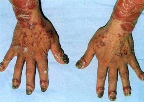 广州银屑病过度治疗的后果 广州银屑病过度治疗的后果