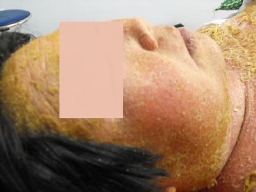 牛皮廨患者如何吃