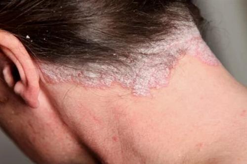 患上牛皮癣需要做哪些检查