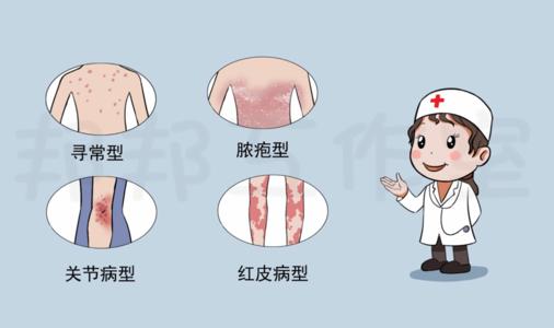 治疗银屑病的方法