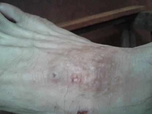 牛皮癣患者如何安全防护