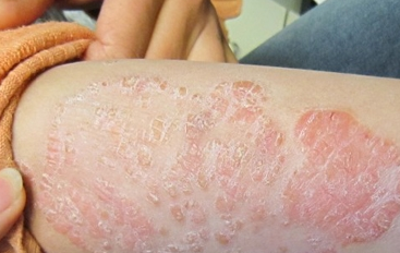 牛皮癣应该如何护理