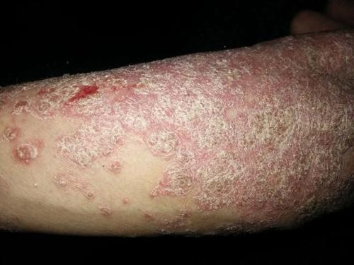 治疗牛皮癣怎么收费