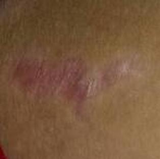 比癌症还可怕的是牛皮癣的隐性危害