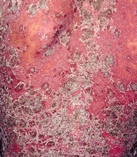 广州治疗牛皮癣医院介绍红皮病型牛皮癣应该如何治疗 广州治疗牛皮癣医院介绍红皮病型牛皮癣应该如何治疗