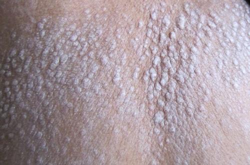 牛皮藓会受到情绪的影响吗