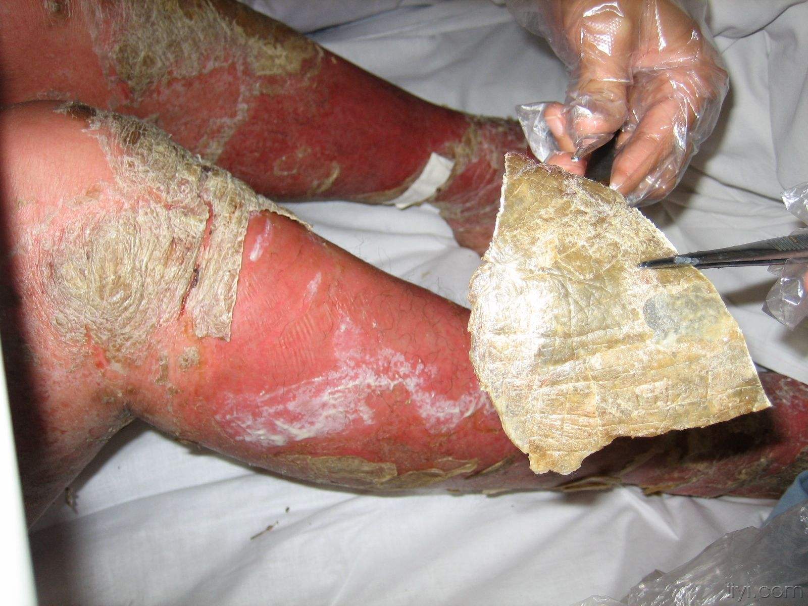 牛皮癣会不会传染