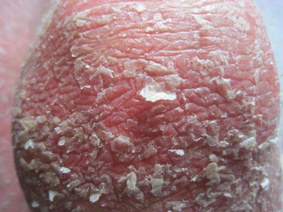 银屑病患者恢复洁净肌肤