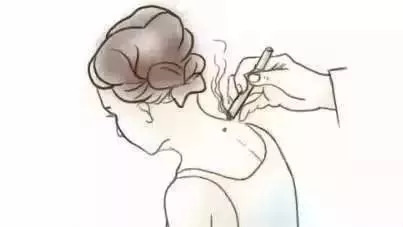 儿童牛皮癣症状特点