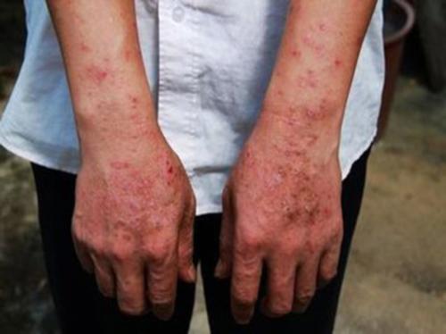 广州治疗牛皮癣哪家医院好