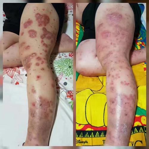 哪里治疗牛皮癣效果好