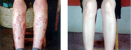 莫要轻视牛皮癣，可能会导致终身瘫痪