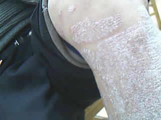 夏季牛皮癣为啥会加重呢