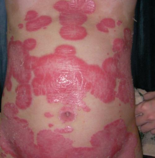 不想被牛皮藓牵鼻子怎么做