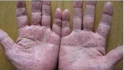 不同人群患上脓疱型牛皮癣的症状是什么 不同人群患上脓疱型牛皮癣的症状是什么