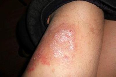 广州医生问影响牛皮鲜皮损愈合的因素有什么 广州医生问影响牛皮鲜皮损愈合的因素有什么