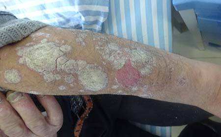 牛皮癣患者控制自己的情绪