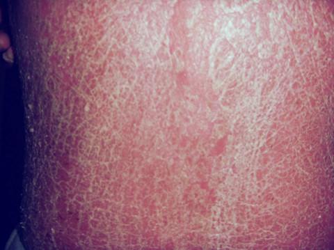 温度骤降牛皮癣如何应对