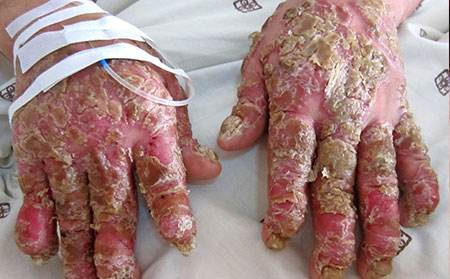 细心的人牛皮癣容易康复