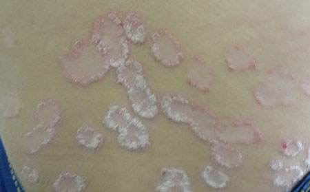 牛皮癣患者可以喝奶茶吗