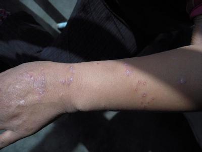 紫外线“杀伤力”强,牛皮癣患者需提高警惕 紫外线“杀伤力”强,牛皮癣患者需提高警惕