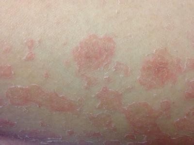 牛皮癣治疗方法