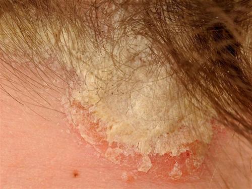 银屑病结痂