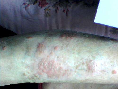 儿童外伤怎么就引发了牛皮鲜呢