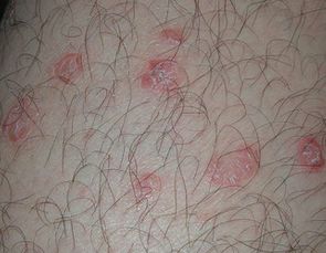 治疗牛皮癣的方法