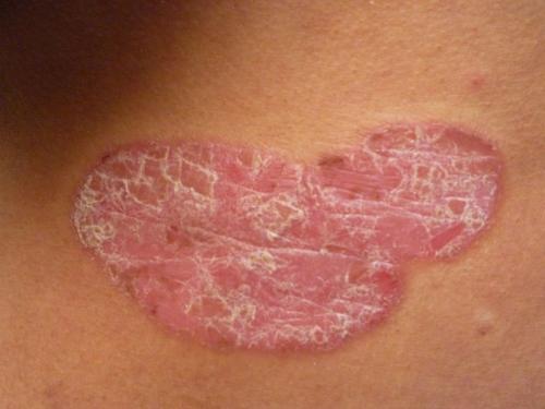 牛皮癣来临皮肤会有什么变化