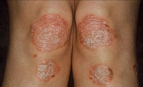 牛皮癣冬重夏轻的特点