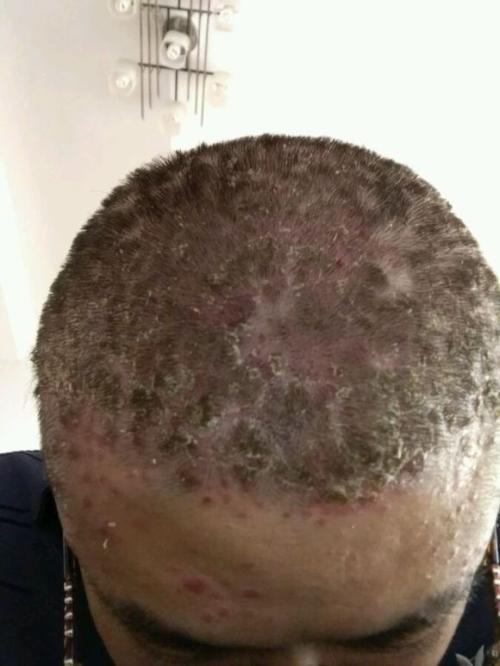 头皮牛皮癣出油多